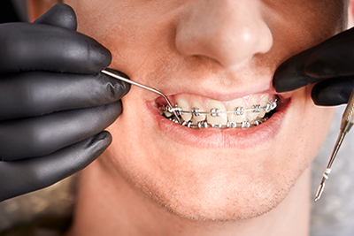 brackets clínica dental Martínez Rioboo ortodoncia en A Coruña