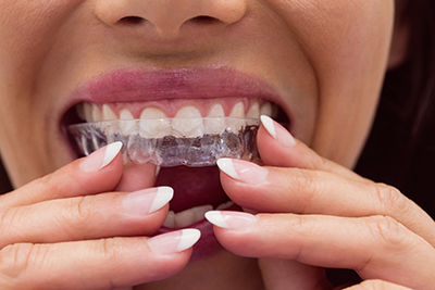 invisalign clínica dental Martínez Rioboo ortodoncia en A Coruña