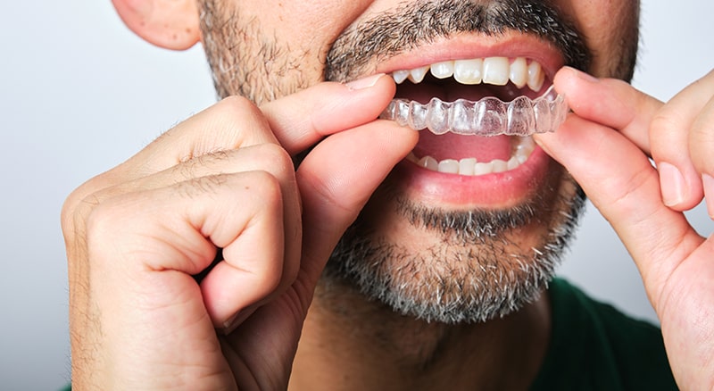 qué es el invisalign