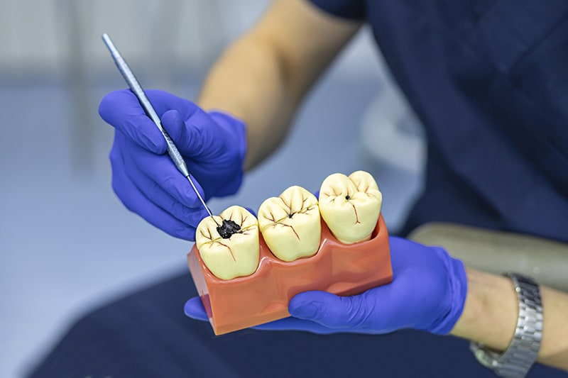 La importancia de las revisiones dentales periódicas: caries