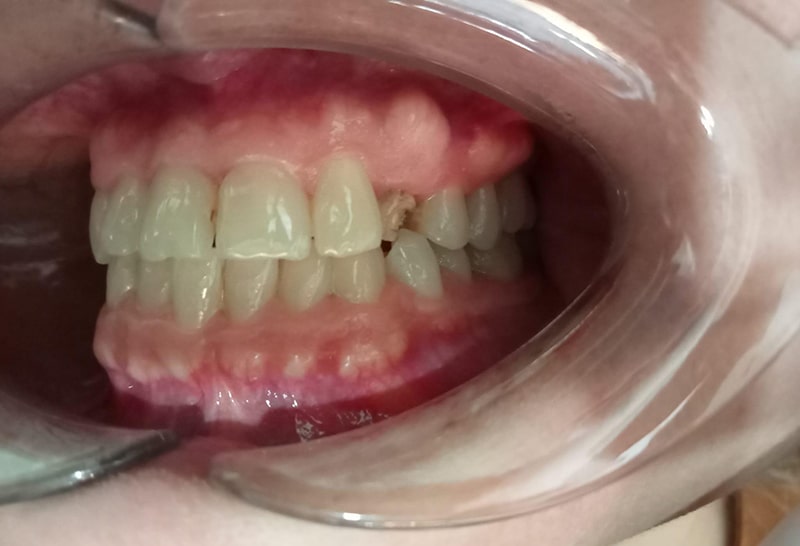 Lesiones infecciosas mandibulares