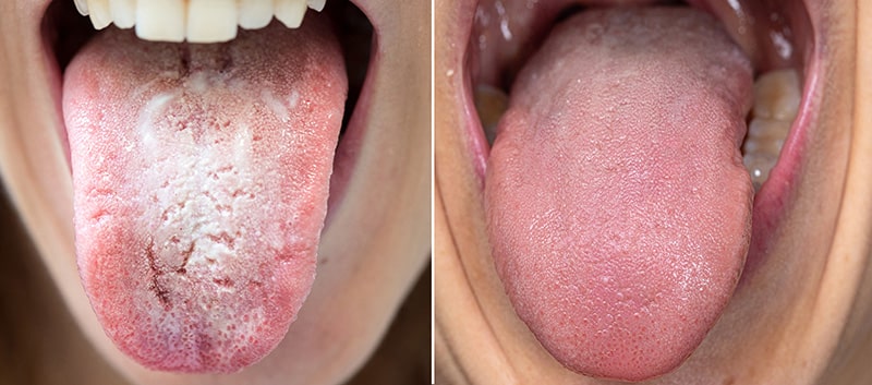 comparación lengua sana lengua con muguet oral