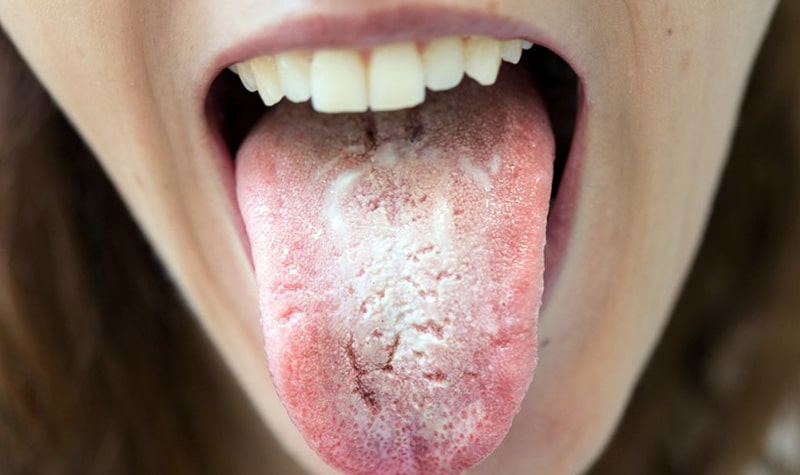 muguet oral candidiasis