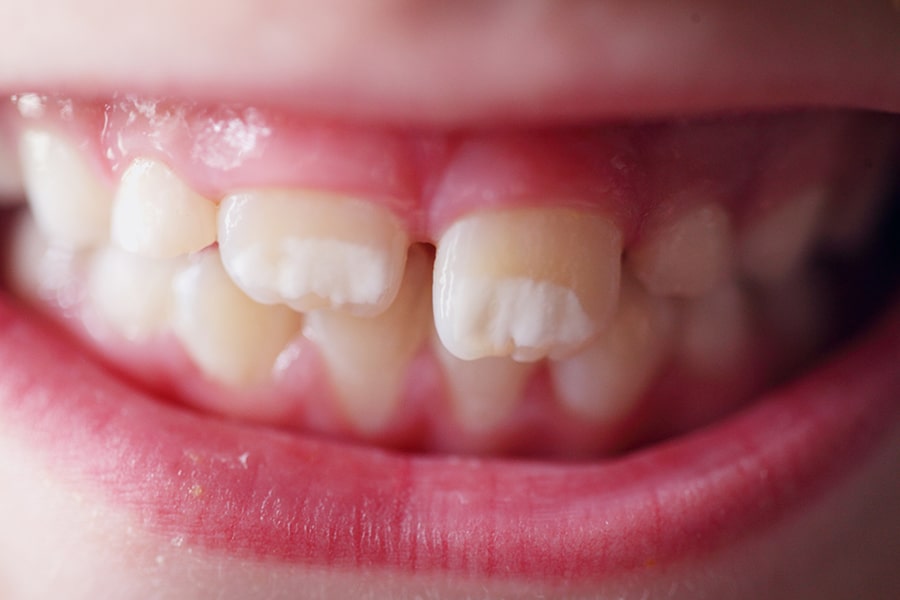 Hipoplasia dental