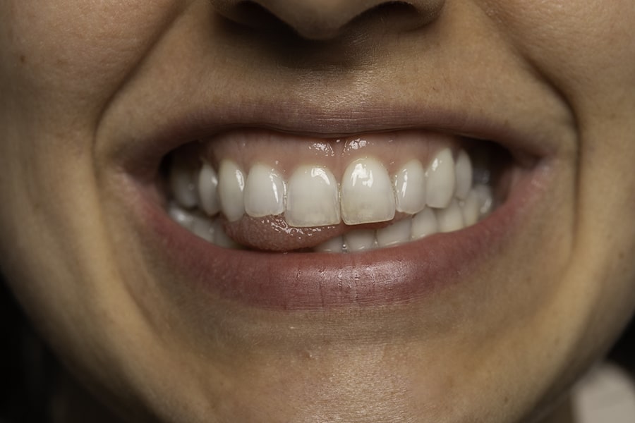 Síntomas hipoplasia dental