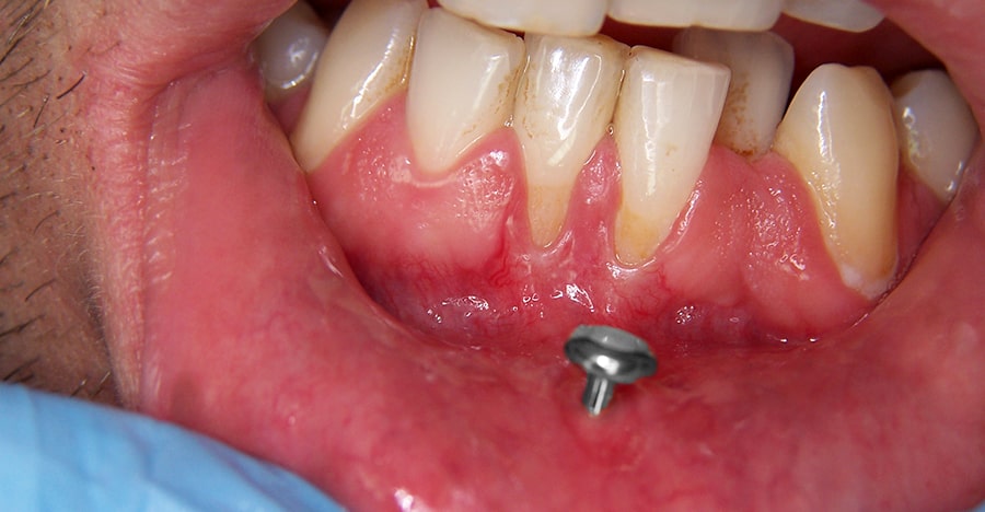 Daños por piercing oral