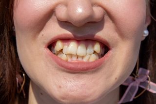 Problemas de mordida y alineación