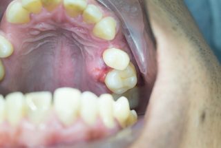 Qué son los abscesos dentales