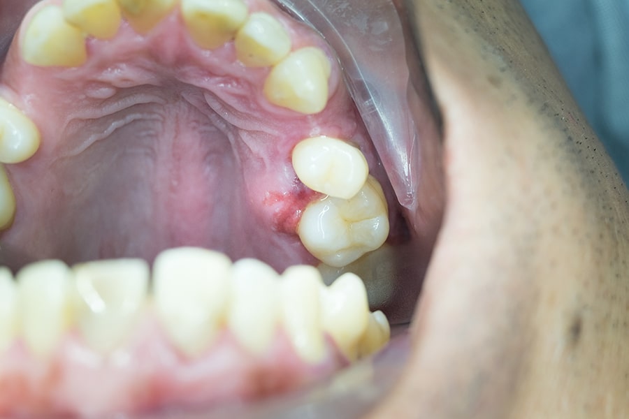 Qué son los abscesos dentales