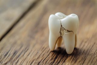 Traumatismos dentales