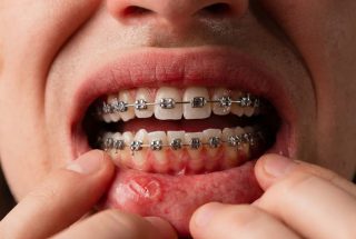 Brackets y llagas bucales