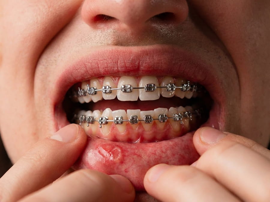 Brackets y llagas bucales