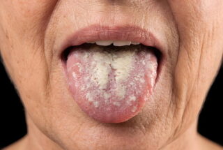 Candidiasis oral en adultos mayores