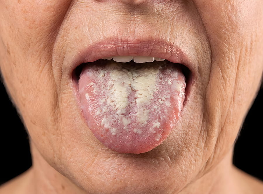 Candidiasis oral en adultos mayores