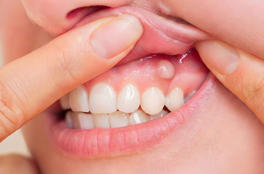 Fístula dental