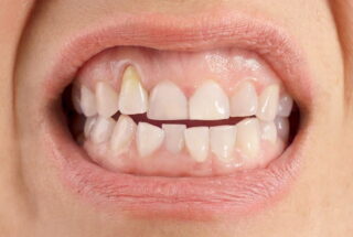 Qué es la recesión gingival y cómo evitarlo