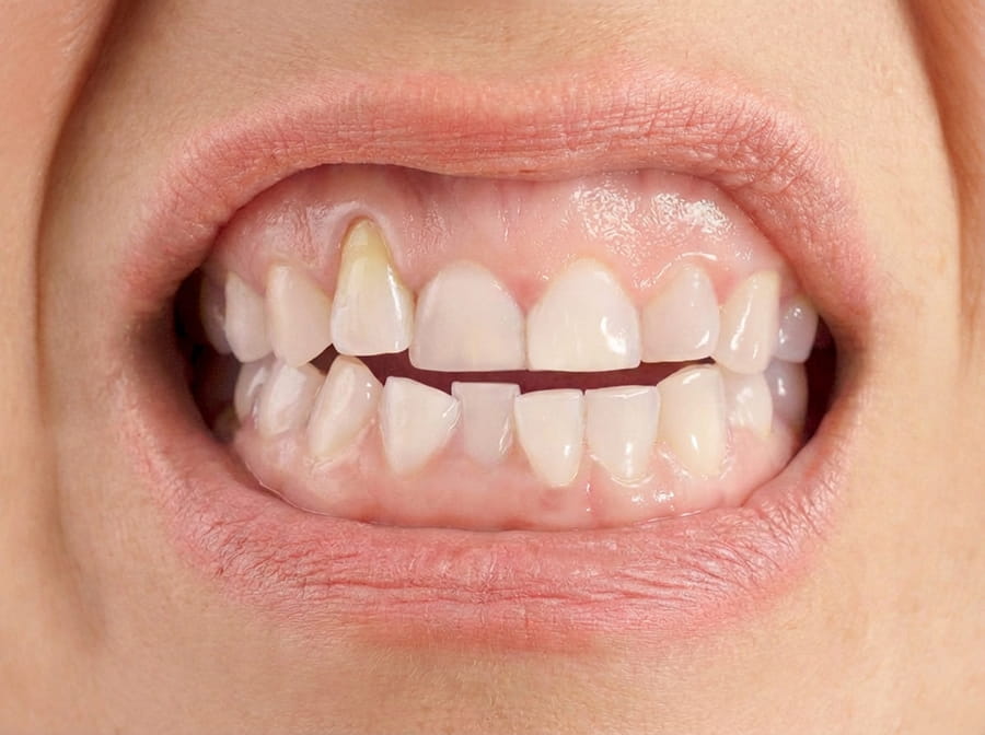 Qué es la recesión gingival y cómo evitarlo