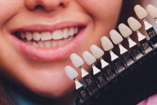 Carillas dentales