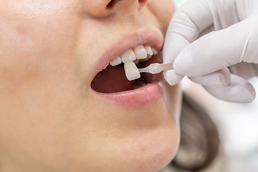 Colocación de las carillas dentales