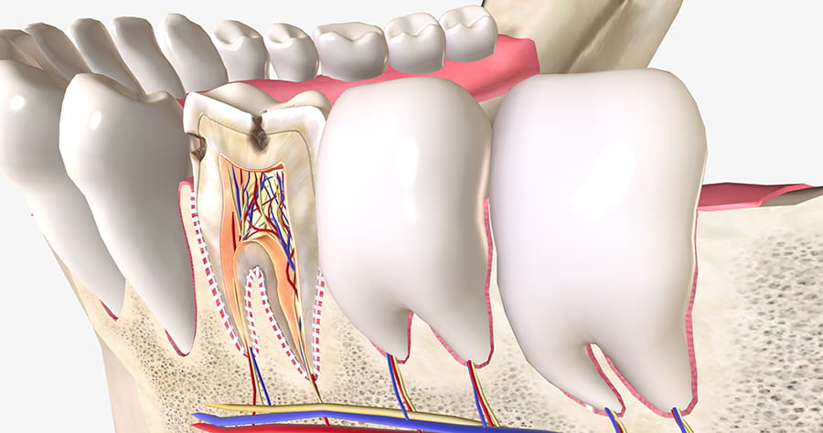 Es mejor extraer el diente o hacer una endodoncia