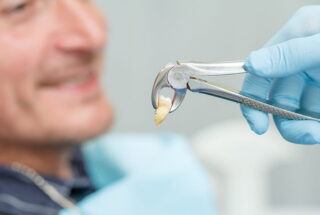 Cuánto tarda en curarse una extracción dental
