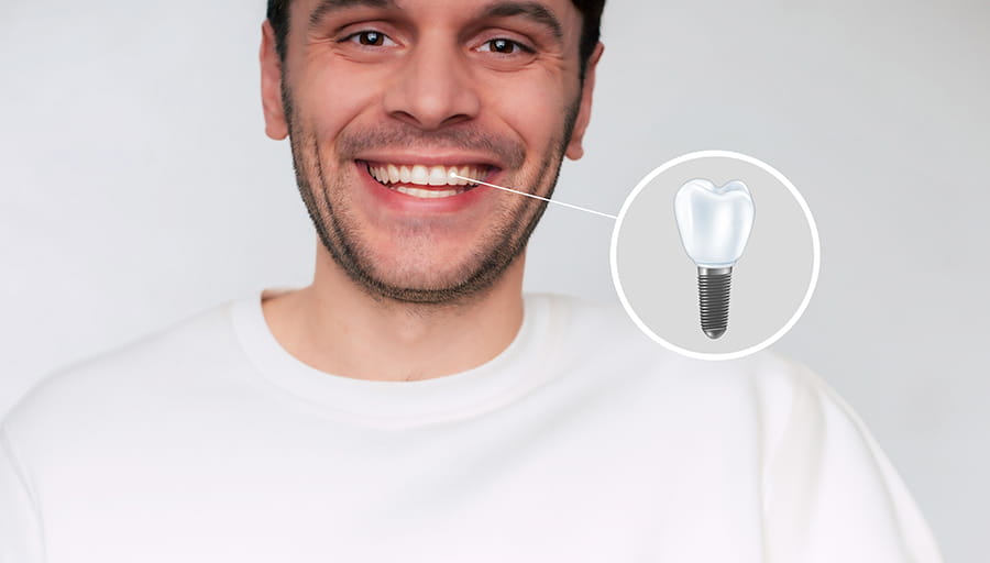 Implantes dentales de circonio o titanio