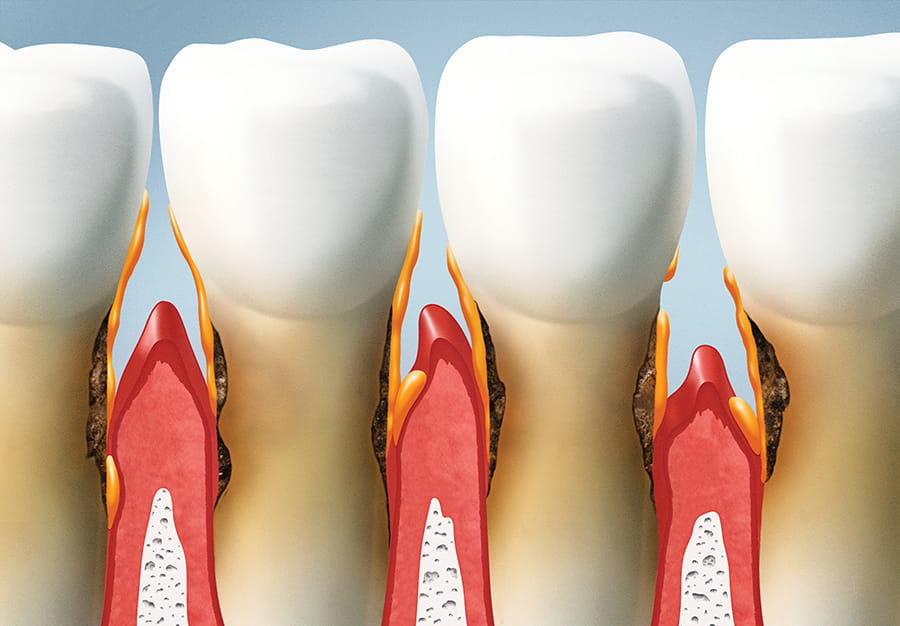 Mantenimiento periodontal